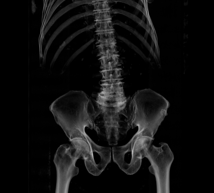 Reconstrucción 3D DICOM real de columna lumbar y pelvis, generada por Circadis